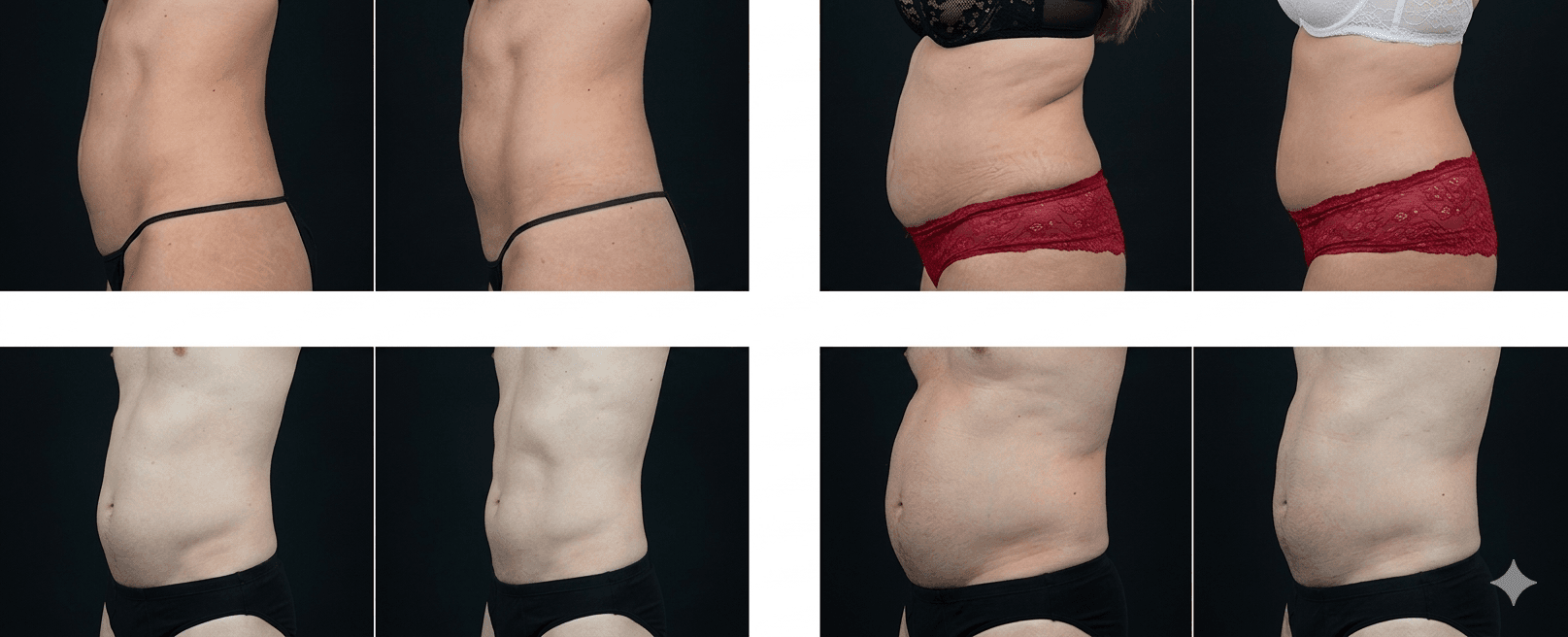 resultaat emsculpt behandeling