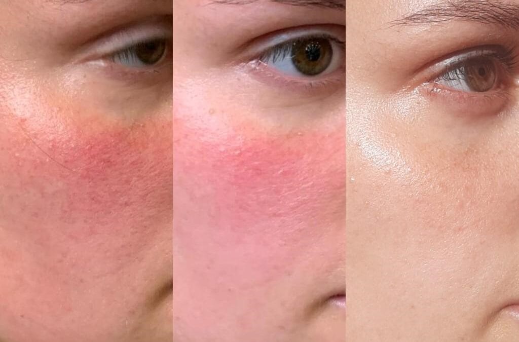 Gevoelige huid? Juist nú is het moment om haar sterker te maken